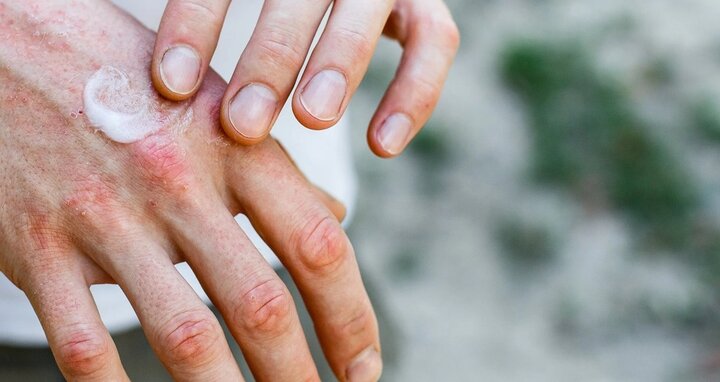 خشکی پوست در پاییز + علت، علائم و راه‌ های پیشگیری