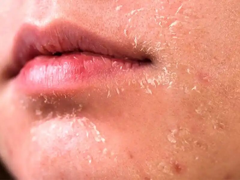 خشکی پوست در پاییز + علت، علائم و راه‌ های پیشگیری