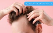 کاشت مو بدون دردسر: نکات کلیدی برای نتیجه‌ای بی‌نقص
