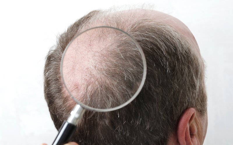 چگونه برای کاشت مو آماده شویم؟