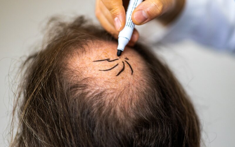 مراقبتهای پس از کاشت مو برای نتیجهای بینقص