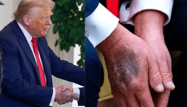 بیماری ترامپ| کبودیها و واکنش پزشکان