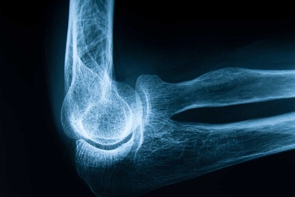 پوکی استخوان؛ نبردی بیصدا در معماری بدن