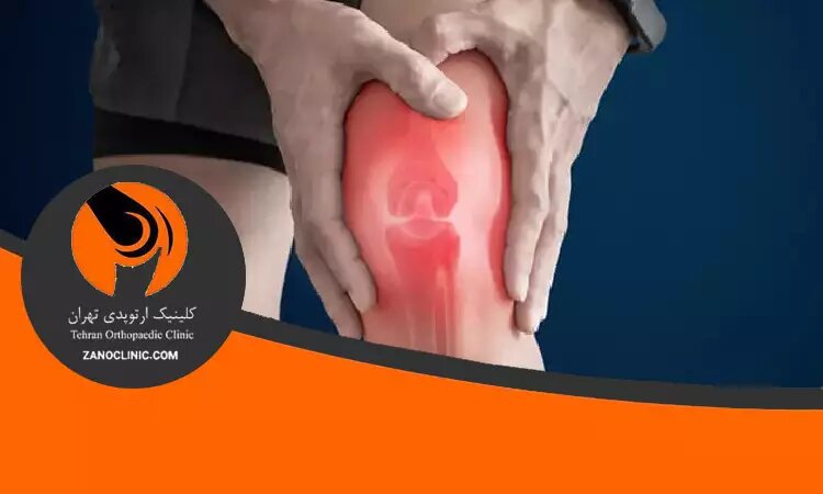 زمان تعویض مفصل زانو