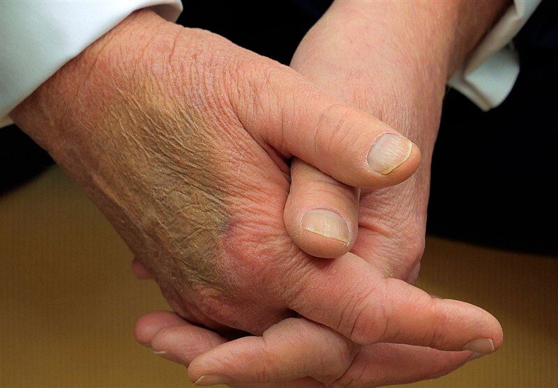 بیماری ترامپ چیست؟ | تلاش دوباره ترامپ برای پنهان کردن کبودی دست راست