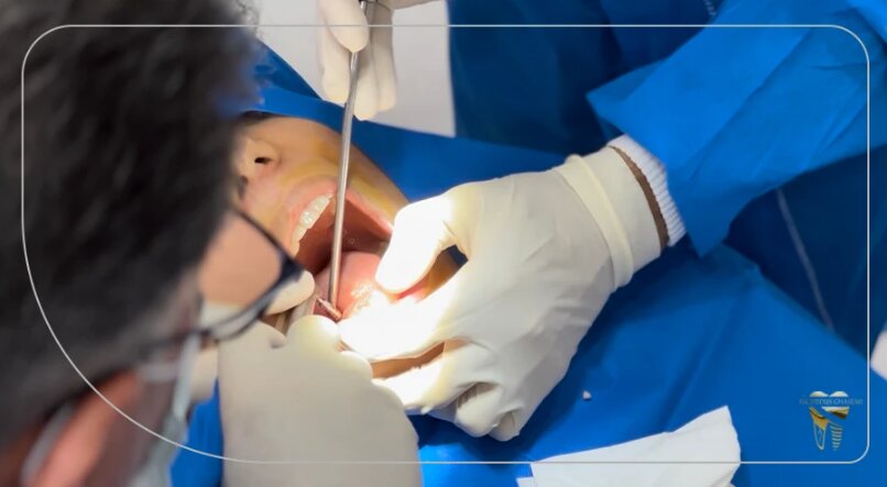 مراحل کاشت ایمپلنت دیجیتال در شرایط تحلیل لثه