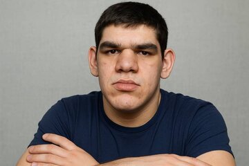 علائم آکرومگالی در نوجوانان و نشانه‌های آن