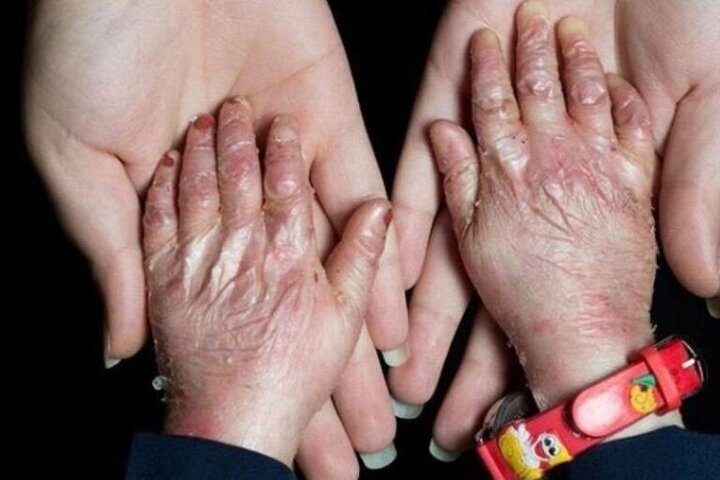 حدود ۲ میلیون بیمار خاص و صعب‌العلاج تحت پوشش بیمه‌ پایه هستند