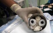 Who Needs a Corneal Transplant? A Specialist Explains