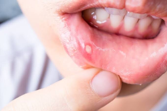 کدام عادات روزانه احتمال بروز سرطان دهان را افزایش می‌دهد؟