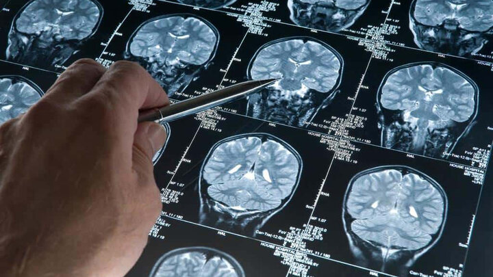 تومورهای مغزی؛ نبردی که با آگاهی آغاز می‌شود