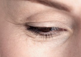 چروک‌های شدید چشمی؛ پیامد هوس برزنزه شدن!