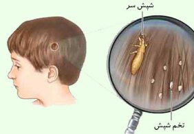 سفر به شهرهای آلوده عامل مهمی در ابتلا به شپش است