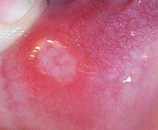 برای درمان آفت دهان از عسل استفاده کنید