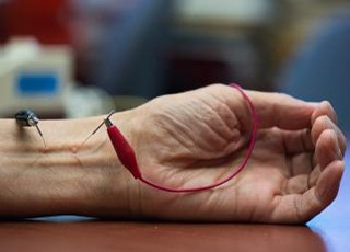 طب سوزنی، روشی موثر برای کاهش فشار خون بالا