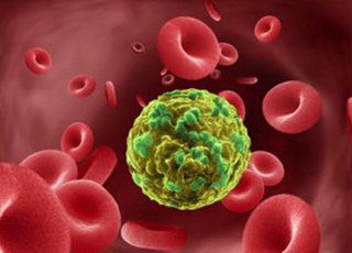 آشنایی با انواع سرطان خون، علایم و نحوه درمان آن