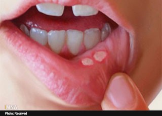 در طب سنتی عامل آفت دهان کبد است/ غذاهای سرخ کرده، چرب و پر ادویه مصرف نکنید